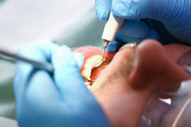 Best Emergency Dentist for Lost Fillings or Crowns in Ione, CA