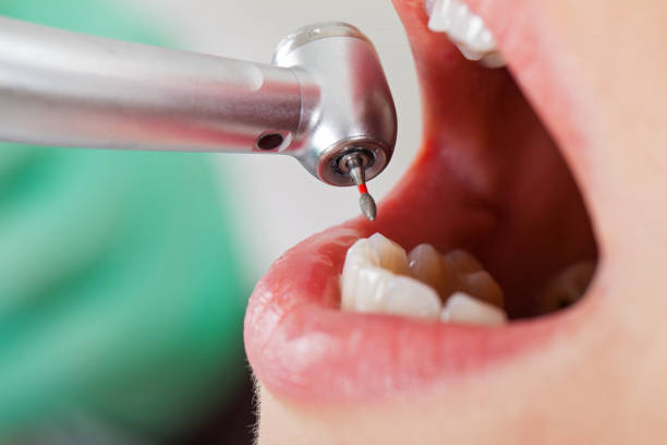 Best Broken or Cracked Tooth Emergency Dentist in Ione, CA